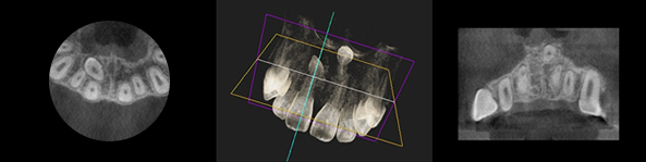 歯科用3D-CT 歯科用3D-CT