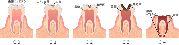 虫歯の進行 虫歯の進行