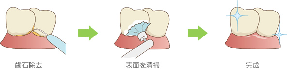 歯のクリーニング 歯のクリーニング